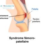 Schéma médical illustrant le syndrome fémoro-patellaire avec vue latérale du genou. La patella est représentée en contact douloureux avec le fémur, provoquant un frottement marqué en rouge. Le tendon patellaire est visible, tout comme les structures musculaires supérieures. Le nom du site LeTraumato.com apparaît en haut à gauche du visuel. Cette image vise à sensibiliser aux douleurs liées à ce syndrome.