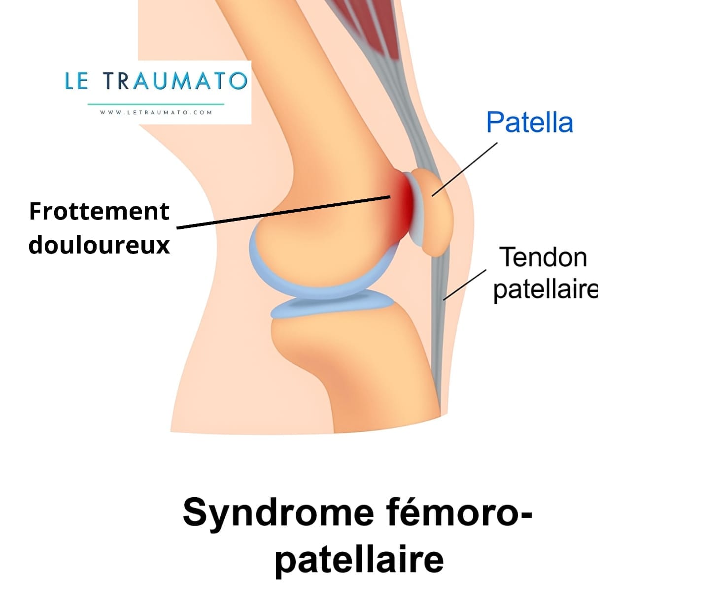Schéma médical illustrant le syndrome fémoro-patellaire avec vue latérale du genou. La patella est représentée en contact douloureux avec le fémur, provoquant un frottement marqué en rouge. Le tendon patellaire est visible, tout comme les structures musculaires supérieures. Le nom du site LeTraumato.com apparaît en haut à gauche du visuel. Cette image vise à sensibiliser aux douleurs liées à ce syndrome.