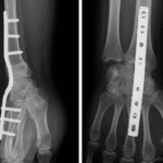 Image médicale montrant deux vues radiographiques d’un poignet après arthrodèse, avec plaque et vis d’ostéosynthèse fixant le radius aux os du carpe, en vues latérale et antéro-postérieure.