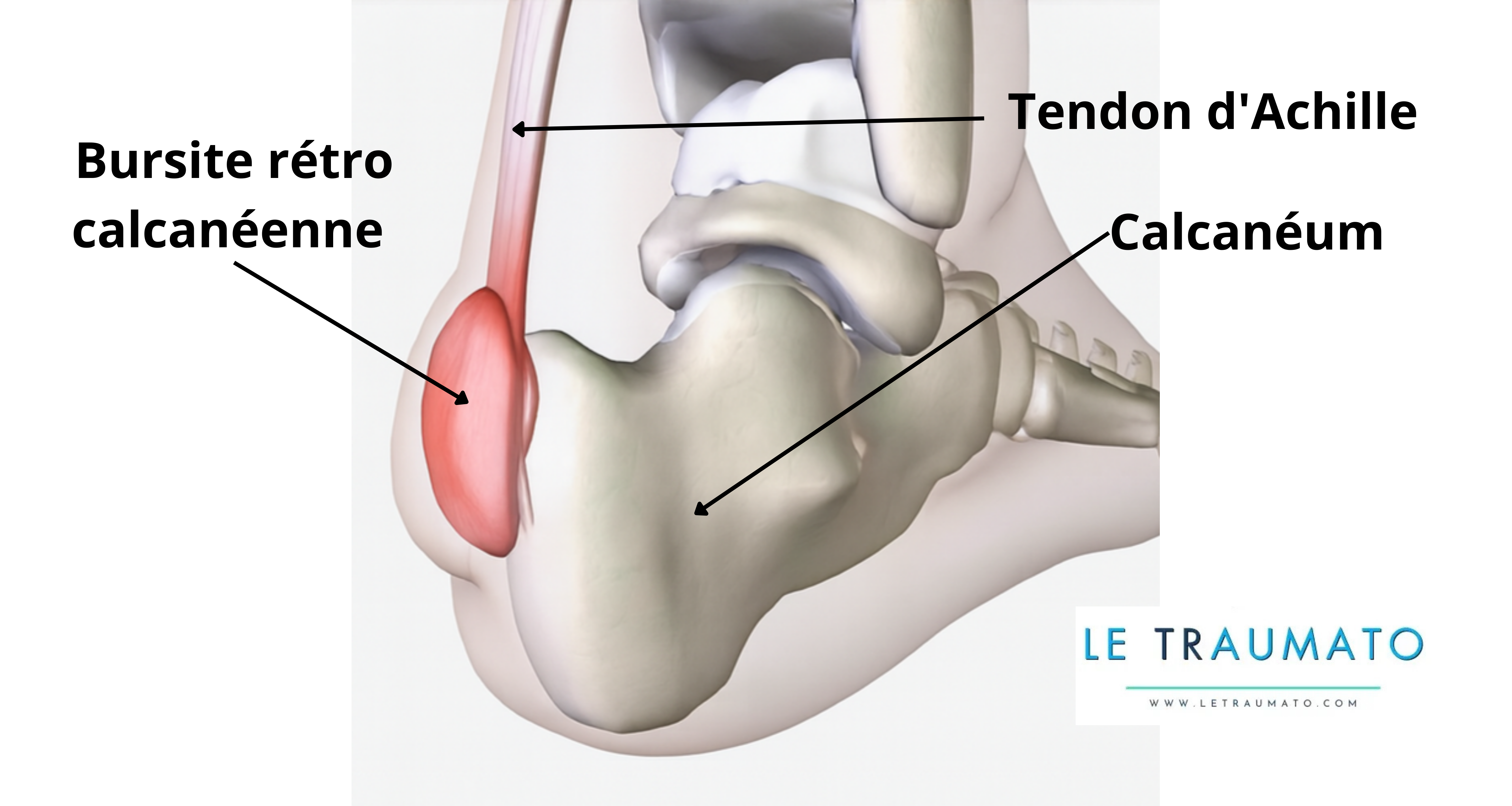 Illustration anatomique 3D du pied montrant une excroissance osseuse du calcanéum et une bursite rétro calcanéenne inflammatoire en rouge – LeTraumato.com