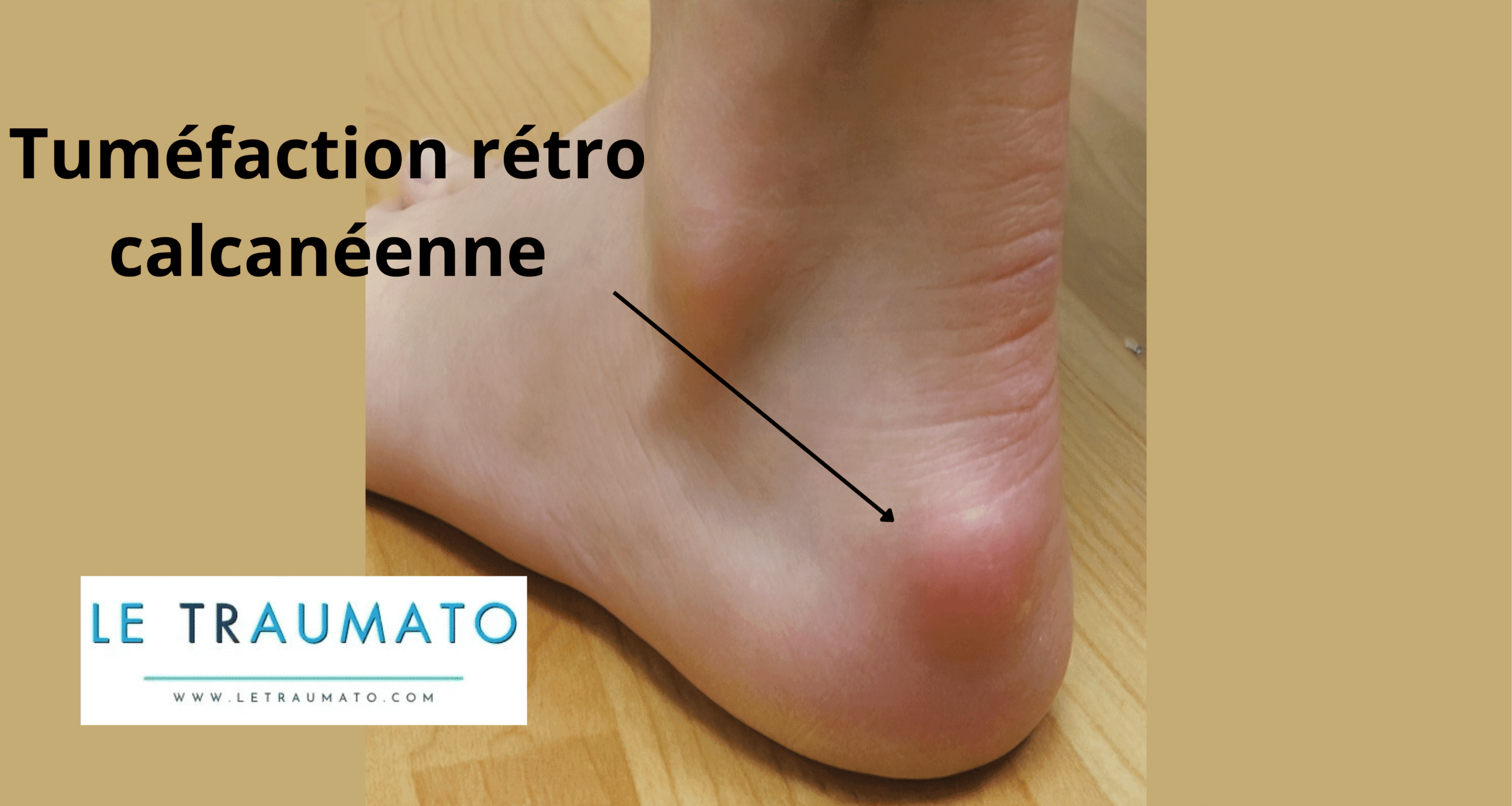 Photo en gros plan d’un pied présentant une bosse douloureuse typique de la maladie de Haglund, cause fréquente de bursite rétro calcanéenne – LeTraumato.com
