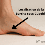 Bursite sous-cuboïdienne – pied réel vu de l’intérieur, illustration par orthopédiste Traumatologie