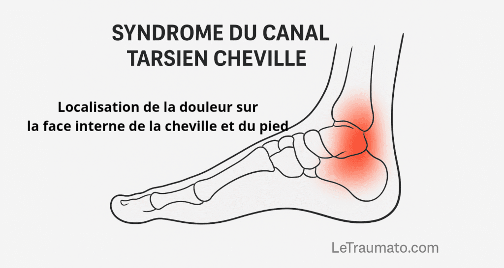 Syndrome du canal tarsien cheville – illustration localisation typique de la douleur orthopédiste Traumatologie
