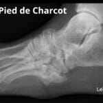 Radiographie en vue latérale d’un pied de Charcot montrant l’effondrement de l’arche plantaire, la fragmentation osseuse et la désorganisation du médio-pied. Illustration pédagogique avec mention LeTraumato.com pour expliquer les complications osseuses liées au diabète et à la neuropathie périphérique.