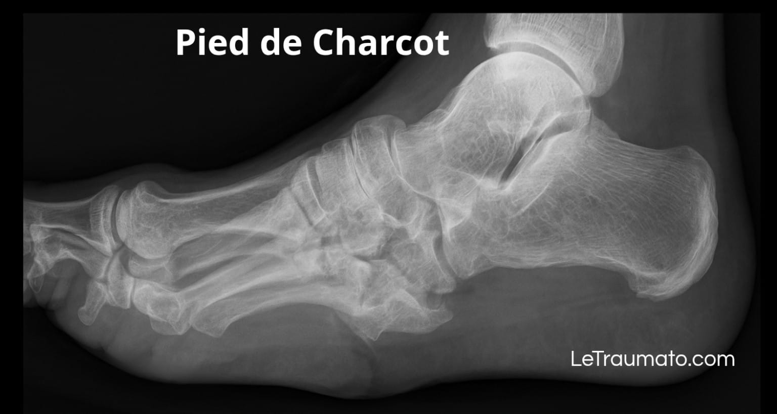 Radiographie en vue latérale d’un pied de Charcot montrant l’effondrement de l’arche plantaire, la fragmentation osseuse et la désorganisation du médio-pied. Illustration pédagogique avec mention LeTraumato.com pour expliquer les complications osseuses liées au diabète et à la neuropathie périphérique.