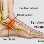 Syndrome du canal tarsien cheville : compression du nerf tibial postérieur illustrée – Infographie médicale LeTraumato