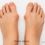 Hallux valgus avec déformation du gros orteil, illustration médicale par un orthopédiste – LeTraumato.com