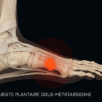 Illustration médicale réaliste d’une bursite plantaire sous-métatarsienne, mise en évidence par un orthopédiste – LeTraumato.com