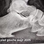 Radiographie du pied gauche montrant une maladie de Haglund avec double épine calcanéenne et atteinte du tendon d’Achille – image médicale LeTraumato.com