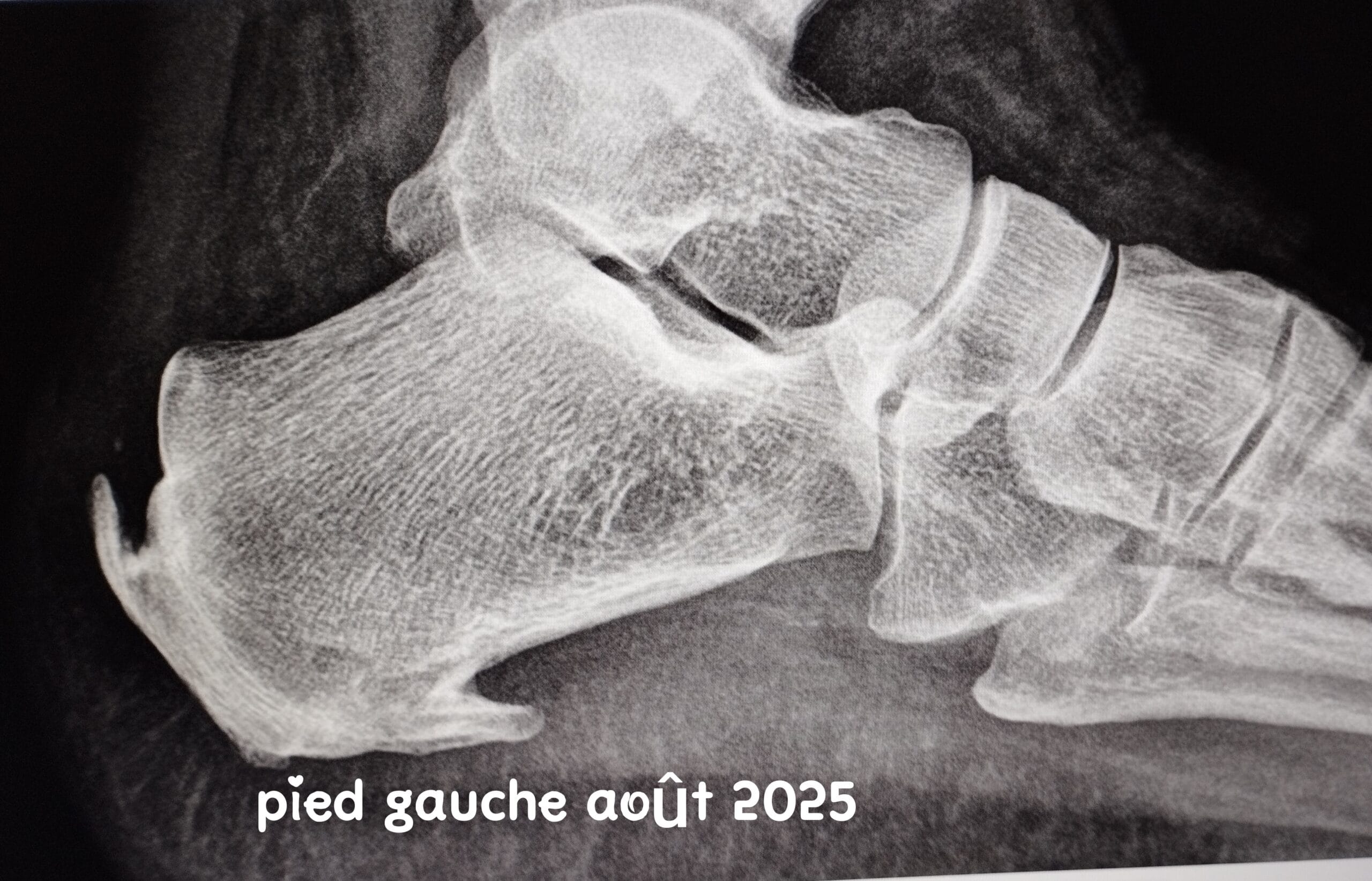 Radiographie du pied gauche montrant une maladie de Haglund avec double épine calcanéenne et atteinte du tendon d’Achille – image médicale LeTraumato.com