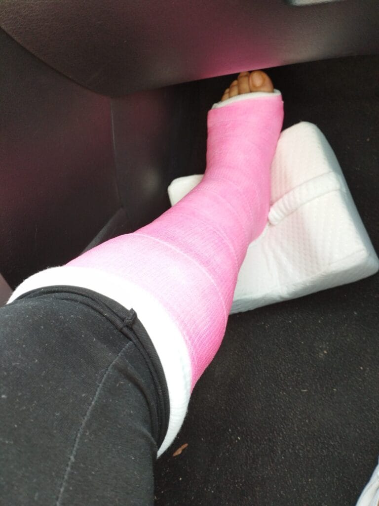 Photo post-opératoire du pied gauche plâtré après chirurgie de la maladie de Haglund avec double épine calcanéenne – orthopédiste LeTraumato.com