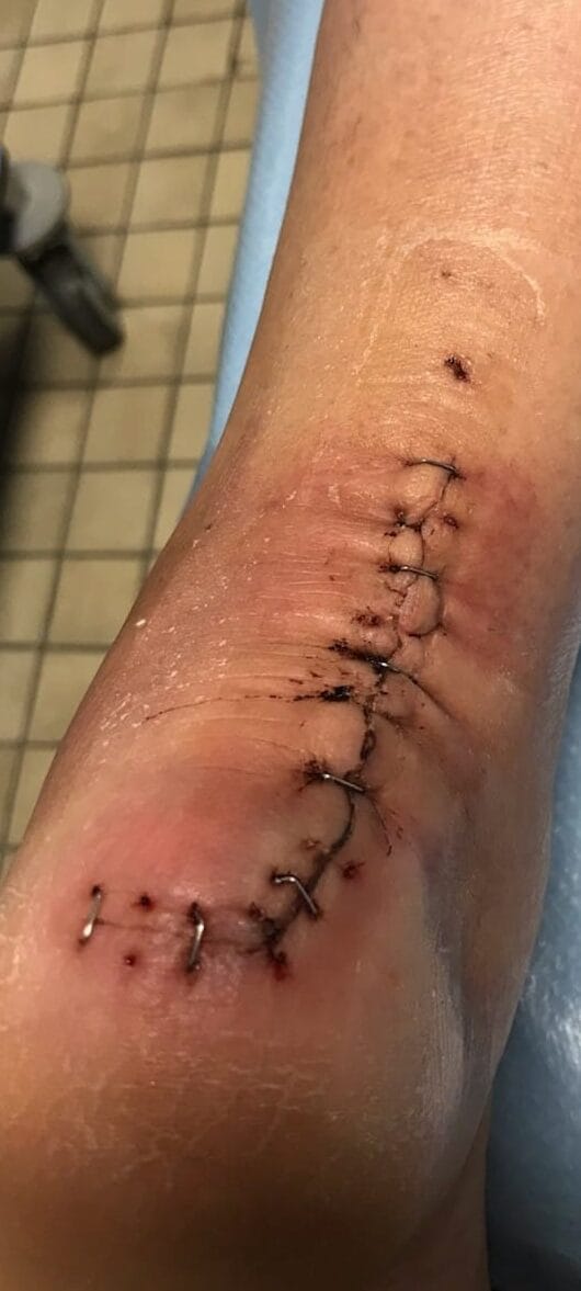 Photo post-opératoire du pied gauche montrant la cicatrice de chirurgie de la maladie de Haglund avec agrafes sur le talon – orthopédiste LeTraumato.com