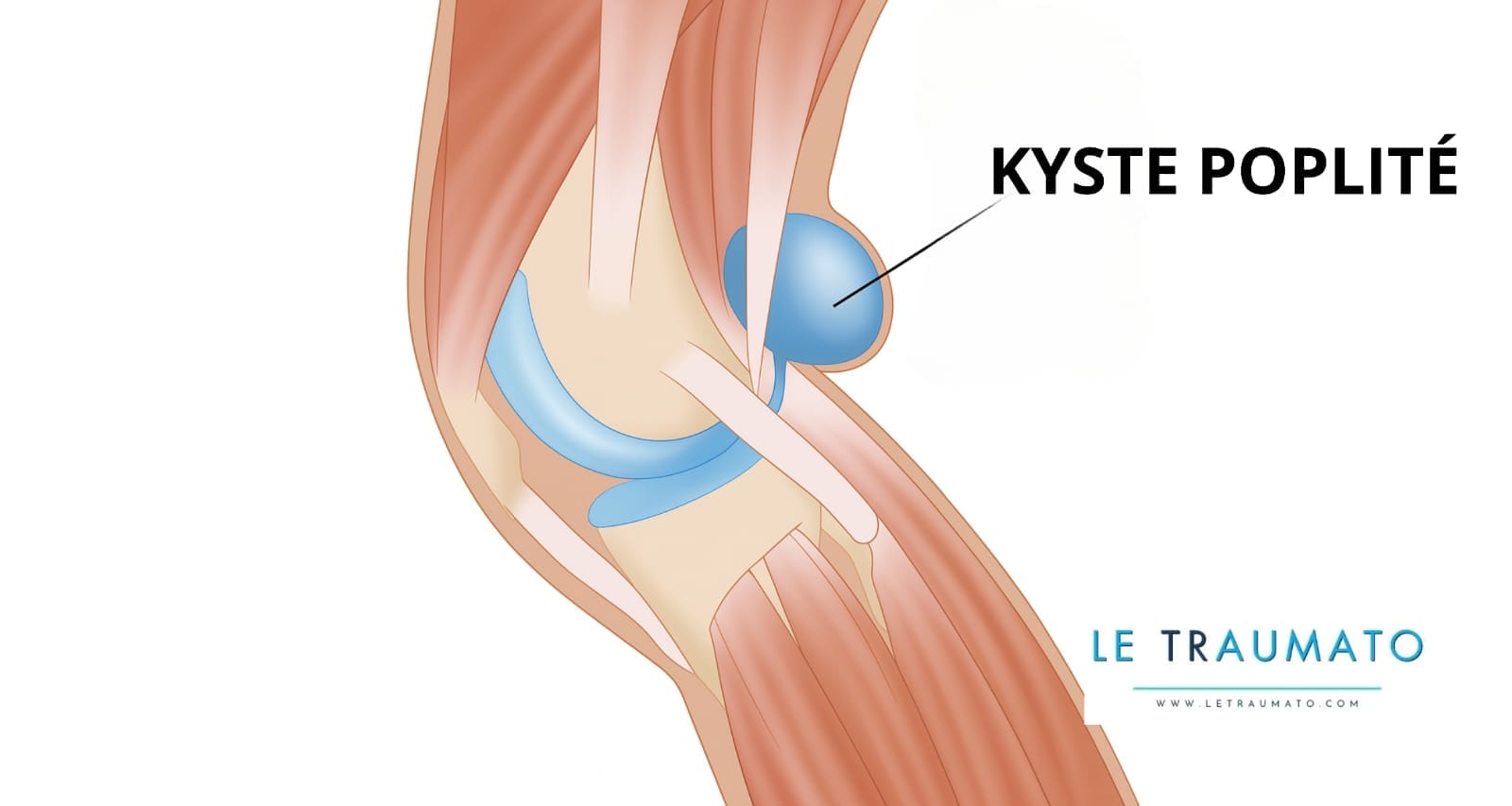 Illustration médicale de la ponction d’un kyste poplité au niveau du genou, réalisée sous conditions stériles par un professionnel de santé. L’image montre une seringue contenant un liquide jaune clair avant aspiration, symbolisant l’évacuation du liquide synovial accumulé derrière le genou. Cette procédure vise à soulager la douleur et la tension dues au kyste poplité. (LeTraumato.com)