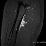 IRM déchirure musculaire cuisse – illustration médicale réaliste par LeTraumato.com orthopédiste traumatologie