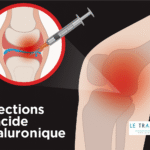 Illustration médicale montrant une injection d’acide hyaluronique dans le genou. On y voit une seringue introduisant le produit dans l’espace intra-articulaire, symbolisé par des gouttes bleues, pour soulager la douleur et améliorer la lubrification du cartilage. Image éducative et claire, utilisée par LeTraumato.com pour expliquer la viscosupplémentation.