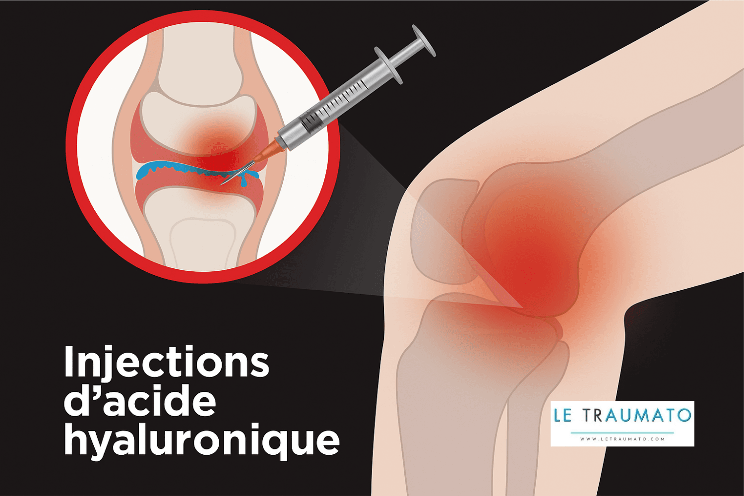 Illustration médicale montrant une injection d’acide hyaluronique dans le genou. On y voit une seringue introduisant le produit dans l’espace intra-articulaire, symbolisé par des gouttes bleues, pour soulager la douleur et améliorer la lubrification du cartilage. Image éducative et claire, utilisée par LeTraumato.com pour expliquer la viscosupplémentation.