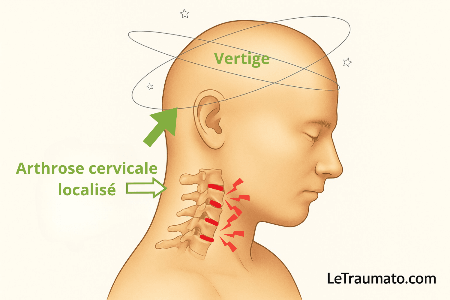 Illustration médicale montrant l’arthrose cervicale localisée avec irritation des vertèbres et vertiges associés, schéma anatomique clair signé LeTraumato.com.