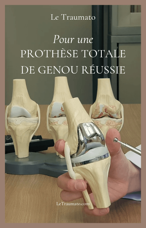 Illustration médicale d’un modèle de prothèse totale de genou montrant l’implant tibial et fémoral, utilisée pour expliquer l’opération et la récupération après PTG.