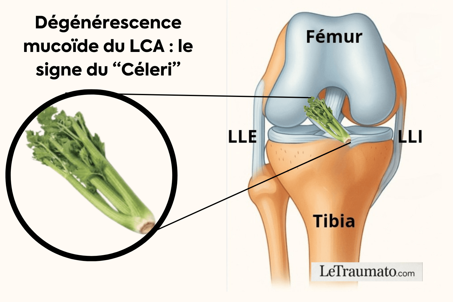 Illustration médicale du genou montrant la dégénérescence mucoïde du ligament croisé antérieur (LCA) avec le “signe du céleri”, où le ligament présente un aspect épaissi et fibreux rappelant une tige de céleri. L’image inclut un schéma anatomique du genou (fémur, tibia, LLI, LLE) et une mise en évidence humoristique et pédagogique du ligament atteint