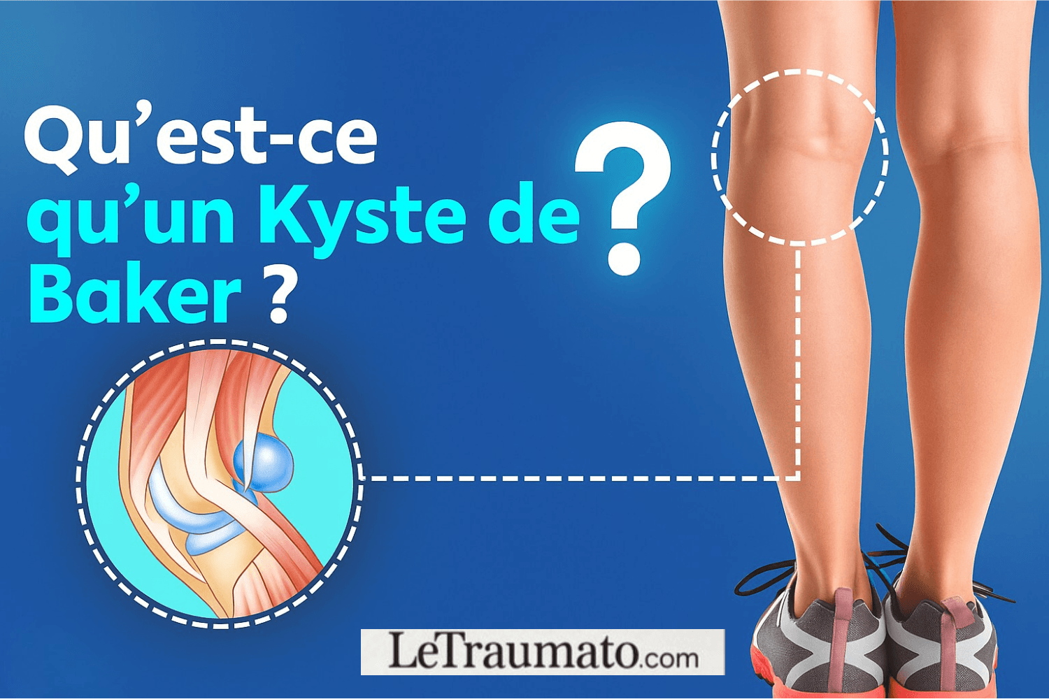 Illustration médicale présentant un kyste de Baker situé à l’arrière du genou, avec un schéma anatomique et une localisation visible au niveau du creux poplité. Ce visuel explique de manière simple ce qu’est un kyste poplité, ses origines articulaires et sa relation avec les structures du genou. Image éducative conçue par LeTraumato.com pour informer les patients sur les pathologies du genou.