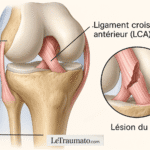 Illustration médicale réaliste montrant la rupture du ligament croisé antérieur (LCA) avec vue anatomique du fémur, du tibia et zoom sur la lésion. LeTraumato.com.