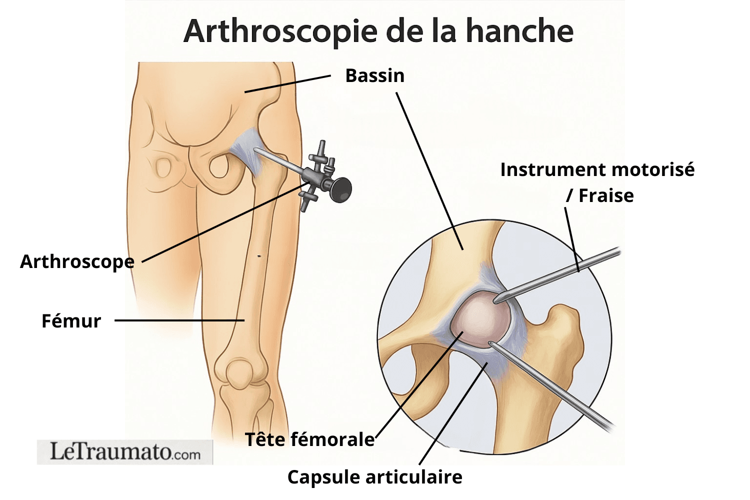Illustration médicale représentant une arthroscopie de la hanche. Le schéma montre l’insertion de l’arthroscope et des instruments dans l’articulation entre le bassin et le fémur, permettant de visualiser la tête fémorale et la capsule articulaire. Ce visuel est conçu pour expliquer la procédure chirurgicale mini-invasive réalisée pour traiter les lésions de la hanche. Marqué LeTraumato.com.