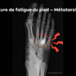 Radiographie du pied montrant une fracture de fatigue du métatarsien, visible sous forme de fine ligne de fissure avec remaniement osseux local. Image pédagogique LeTraumato.com.