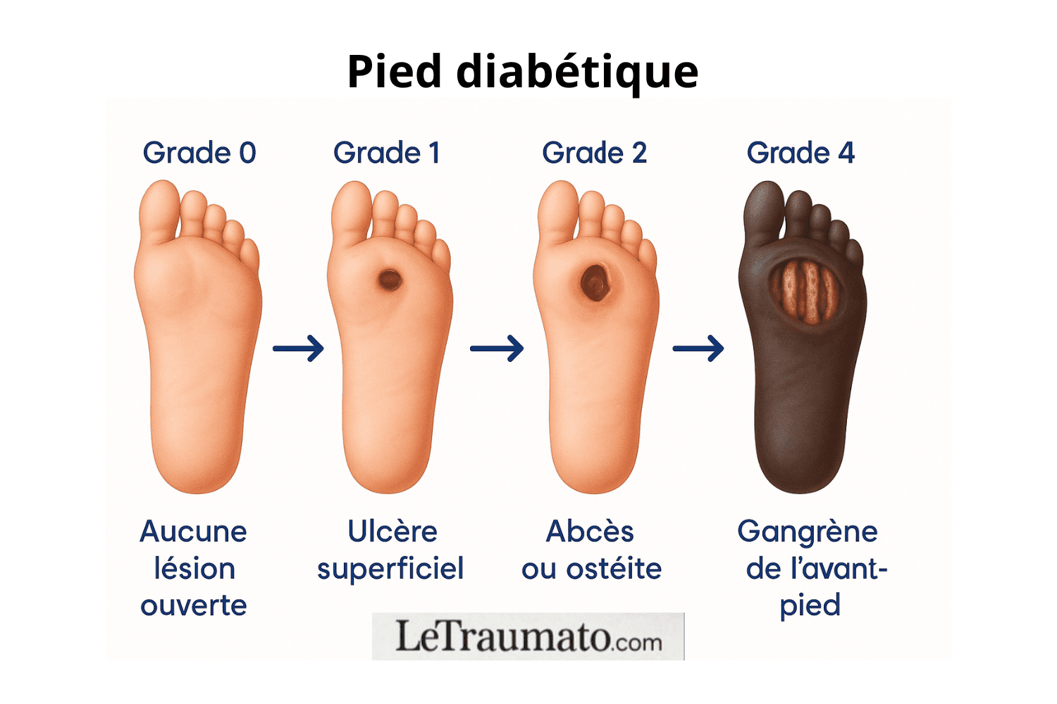 Illustration médicale montrant l’évolution du pied diabétique depuis l’absence de lésion (grade 0) jusqu’à la gangrène de l’avant-pied (grade 4), avec ulcère superficiel, ulcère profond et infection ostéo-articulaire. Visuel éducatif LeTraumato.com.