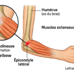 Illustration médicale en vue latérale du coude et de l’avant-bras montrant l’épicondyle latéral de l’humérus, l’insertion des muscles extenseurs et une zone rouge inflammatoire correspondant à une lésion tendineuse typique du tennis elbow avec un zoom sur les micro-déchirures du tendon
