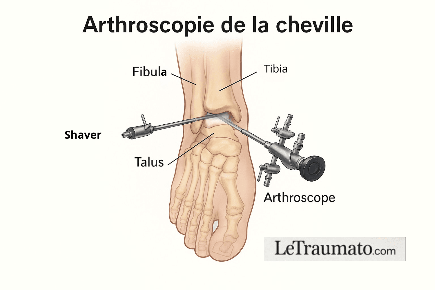 Illustration de l’arthroscopie de la cheville montrant les instruments chirurgicaux et l’anatomie : tibia, fibula, talus, arthroscope et canule. Image éducative LeTraumato.com.