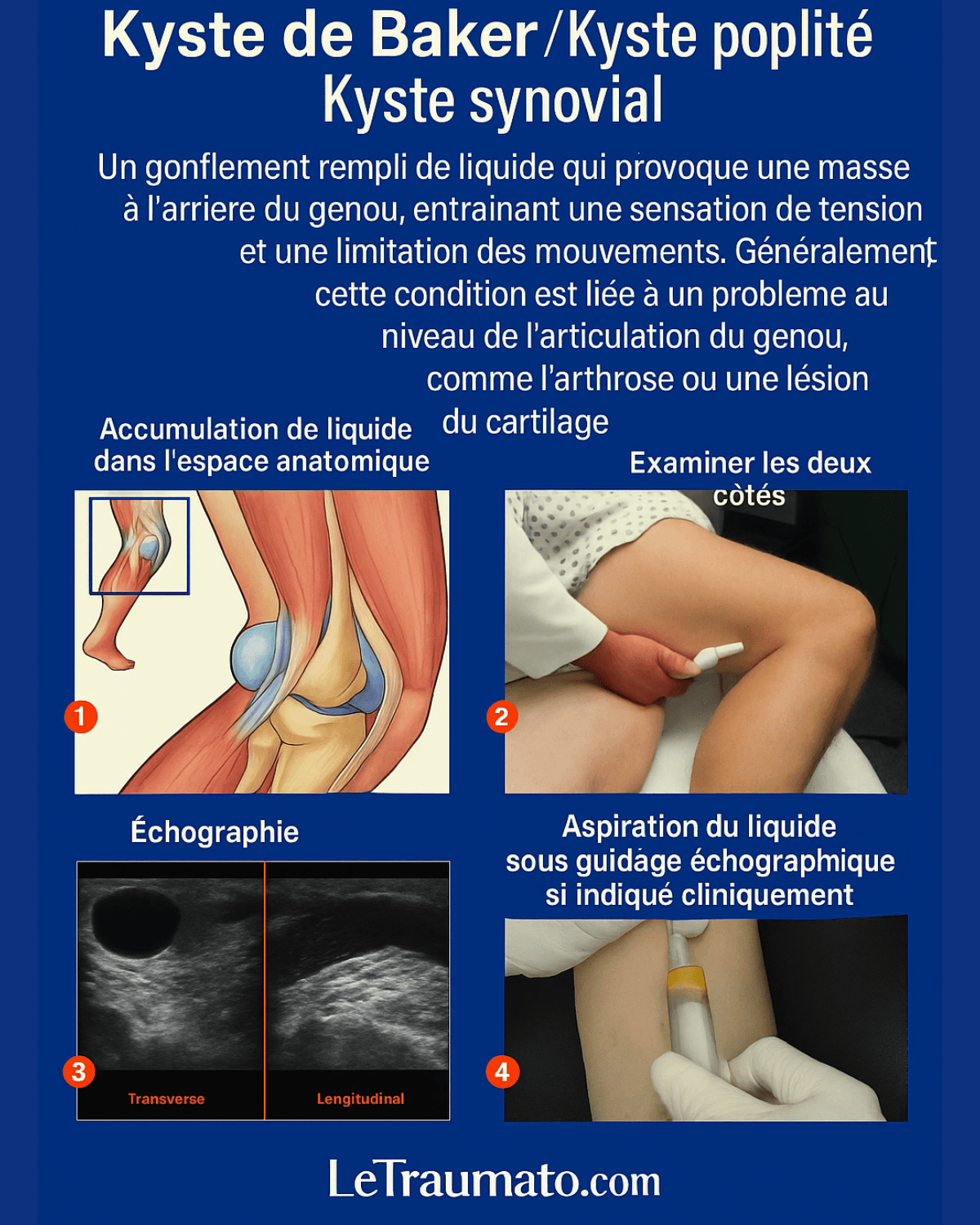 Infographie médicale en français expliquant le kyste de Baker, également appelé kyste poplité, avec schéma anatomique du genou, images d’échographie en coupe transverse et longitudinale, examen clinique du creux poplité, et aspiration sous guidage échographique. Contenu éducatif pour comprendre la formation, le diagnostic et la prise en charge du kyste poplité. Illustration signée LeTraumato.com.