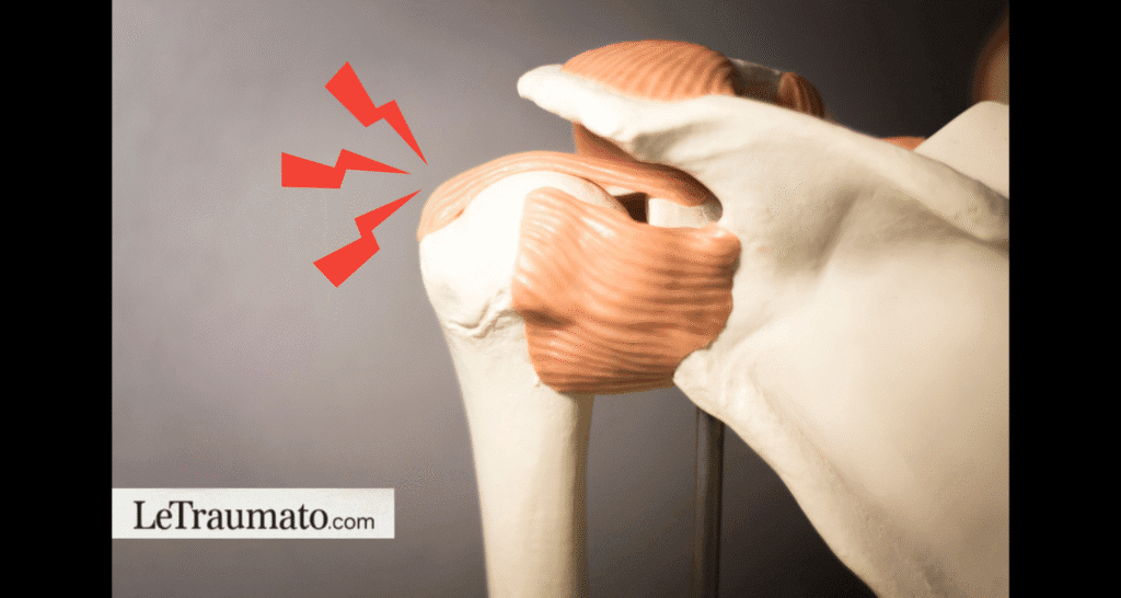 Illustration médicale montrant l’inflammation des tendons de la coiffe des rotateurs au niveau de l’épaule, évoquant une tendinite avec douleur localisée – LeTraumato.com.
