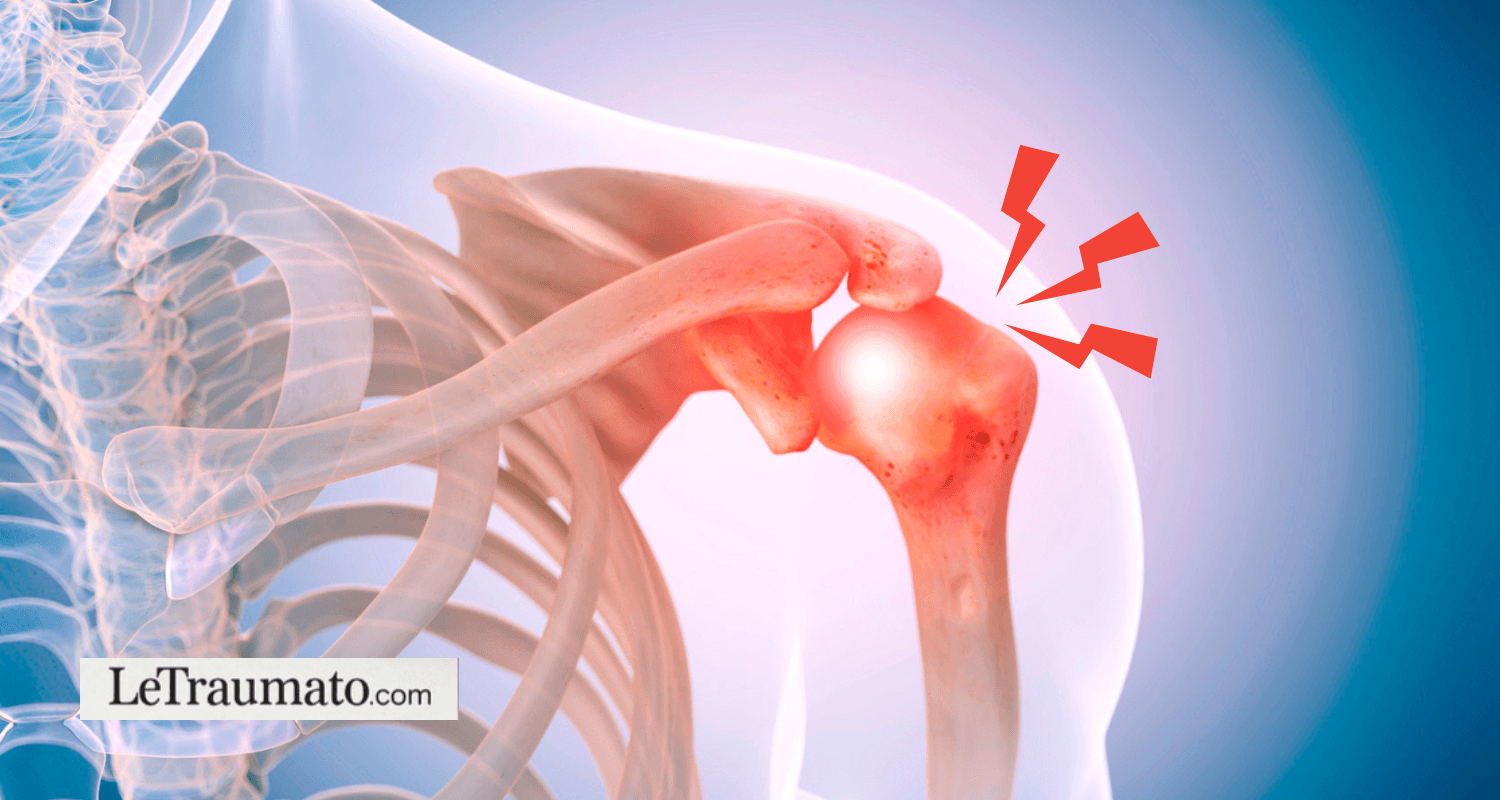 Tendinite de l’épaule – Inflammation de la coiffe des rotateurs – Illustration anatomique LeTraumato.com