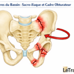 Illustration médicale du bassin montrant une fracture sacro-iliaque droite associée à une fracture du cadre obturateur du même côté, zones fracturées en rouge et flèche indiquant le mécanisme lésionnel, image pédagogique LeTraumato.com