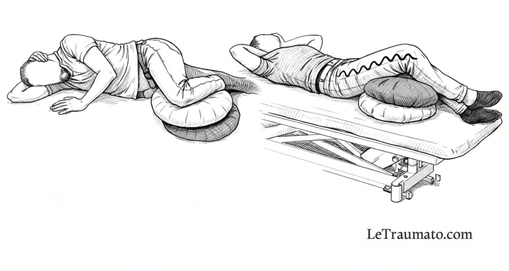 Illustration médicale en noir et blanc montrant deux positions de sommeil adaptées en cas de cruralgie, l’une en décubitus latéral avec coussins de soutien entre les jambes, l’autre en décubitus dorsal avec les membres inférieurs surélevés, visant à réduire la compression du nerf fémoral et soulager les douleurs nocturnes, sans représentation du visage, LeTraumato.com