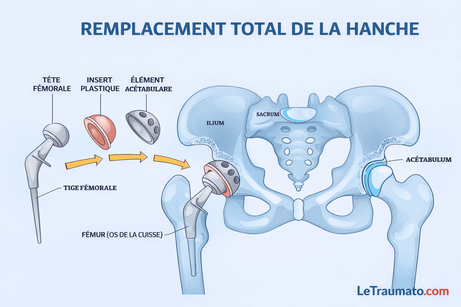 Illustration médicale détaillée du remplacement total de la hanche montrant les composants de la prothèse de hanche incluant la tête fémorale, l’insert plastique, l’élément acétabulaire et la tige fémorale, avec représentation anatomique du bassin et du fémur, schéma pédagogique destiné à l’information des patients, marque LeTraumato.com