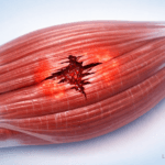 Illustration médicale montrant une déchirure musculaire partielle avec rupture des fibres musculaires, inflammation locale et micro hémorragie, image pédagogique utilisée en traumatologie et médecine du sport