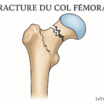 Illustration médicale montrant une fracture du col fémoral, avec la tête du fémur séparée du col par un trait de fracture irrégulier. Image pédagogique destinée à expliquer cette blessure fréquente de la hanche.
