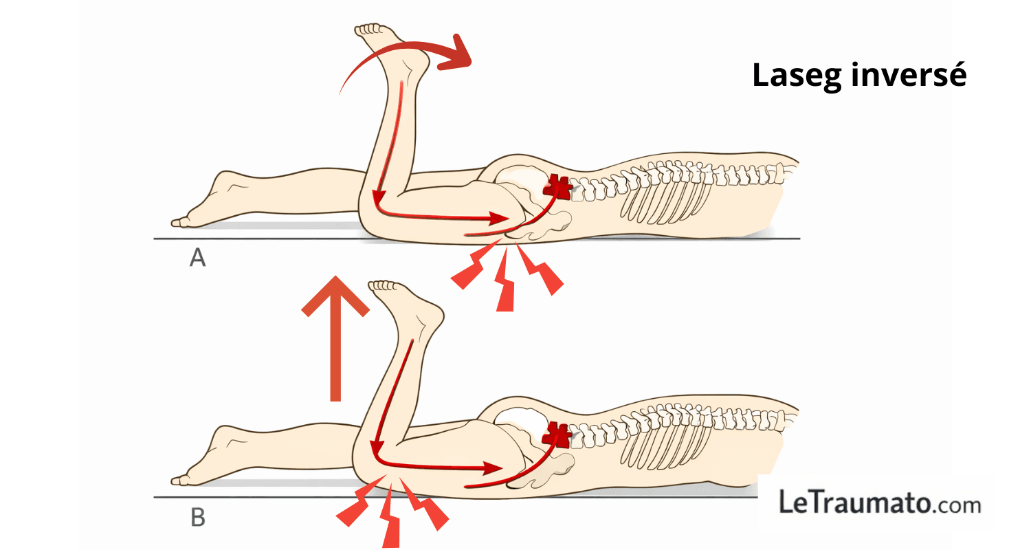 Illustration médicale pédagogique du test de Lasègue inversé montrant la flexion du genou en décubitus ventral augmentant la tension du nerf crural, avec flèches rouges indiquant les contraintes lombaires et fémorales, sans visage ni personnage, LeTraumato.com