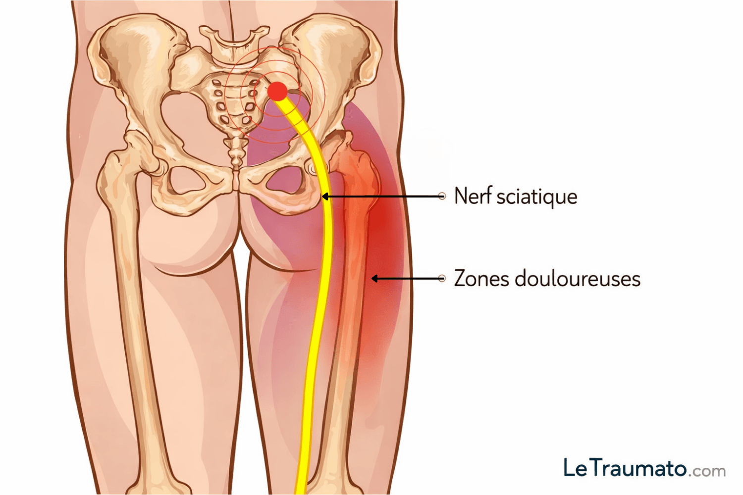 Illustration médicale montrant le trajet du nerf sciatique depuis la région lombosacrée jusqu’à la cuisse, avec mise en évidence des zones douloureuses irradiantes en rouge, vue postérieure du bassin et des membres inférieurs, image pédagogique sur la sciatique.