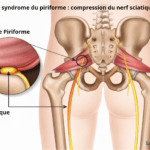 Illustration médicale montrant la compression du nerf sciatique par le muscle piriforme au niveau du bassin, avec visualisation du sacrum, des hanches et du trajet du nerf sciatique, expliquant l’origine des douleurs sciatiques liées au syndrome du piriforme. Image pédagogique destinée à l’information médicale des patients. LeTraumato.com