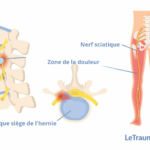 Illustration médicale de la sciatique montrant un disque lombaire hernié comprimant le nerf sciatique et le trajet de la douleur dans la jambe