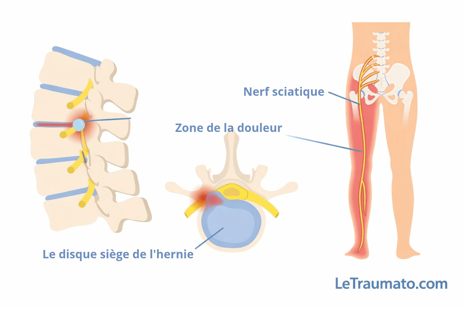 Illustration médicale de la sciatique montrant un disque lombaire hernié comprimant le nerf sciatique et le trajet de la douleur dans la jambe