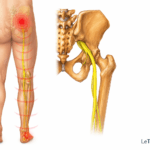 Illustration médicale montrant la sciatique avec le trajet anatomique du nerf sciatique depuis la région lombaire et fessière jusqu’à la jambe et au pied. Le nerf sciatique est mis en évidence en jaune avec des zones rouges représentant la douleur irradiée typique. Image pédagogique destinée à expliquer les douleurs sciatiques, réalisée pour LeTraumato.com.