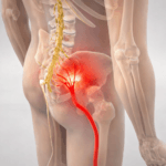 Illustration médicale montrant le nerf sciatique en rouge depuis la colonne lombaire jusqu’à la cuisse, avec zone douloureuse au bassin