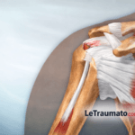 Illustration anatomique détaillée de la tendinite de l’épaule montrant l’inflammation du tendon du supra-épineux au niveau de l’articulation gléno-humérale, image médicale pédagogique signée LeTraumato.com