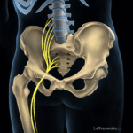 Illustration médicale détaillée montrant le trajet anatomique du nerf sciatique depuis les racines lombaires et sacrées à travers le bassin et la hanche, avec visualisation précise du sacrum, du bassin et du fémur. Le nerf sciatique est mis en évidence en jaune sur fond sombre afin d’illustrer les mécanismes de la douleur sciatique et ses zones de compression possibles. Image pédagogique destinée à l’information médicale sur la sciatique.