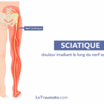 Illustration médicale de la sciatique montrant le trajet anatomique du nerf sciatique depuis la région lombaire et le bassin, traversant la fesse, l’arrière de la cuisse, le mollet jusqu’au pied, avec une zone de douleur irradiée en rouge le long du membre inférieur. Schéma pédagogique clair destiné à expliquer les mécanismes de la sciatique, ses symptômes et la douleur nerveuse. Image informative pour patients et professionnels de santé par LeTraumato.com.