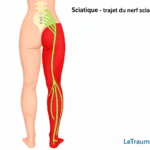 Illustration médicale montrant le trajet anatomique du nerf sciatique depuis la colonne lombaire L4 L5 S1 S2 S3 jusqu’à la jambe et au pied. Le nerf est représenté en vert et la zone douloureuse typique de la sciatique en rouge, au niveau de la fesse, de la cuisse, du mollet et du pied. Schéma pédagogique clair destiné à expliquer l’origine et la propagation des douleurs sciatiques.