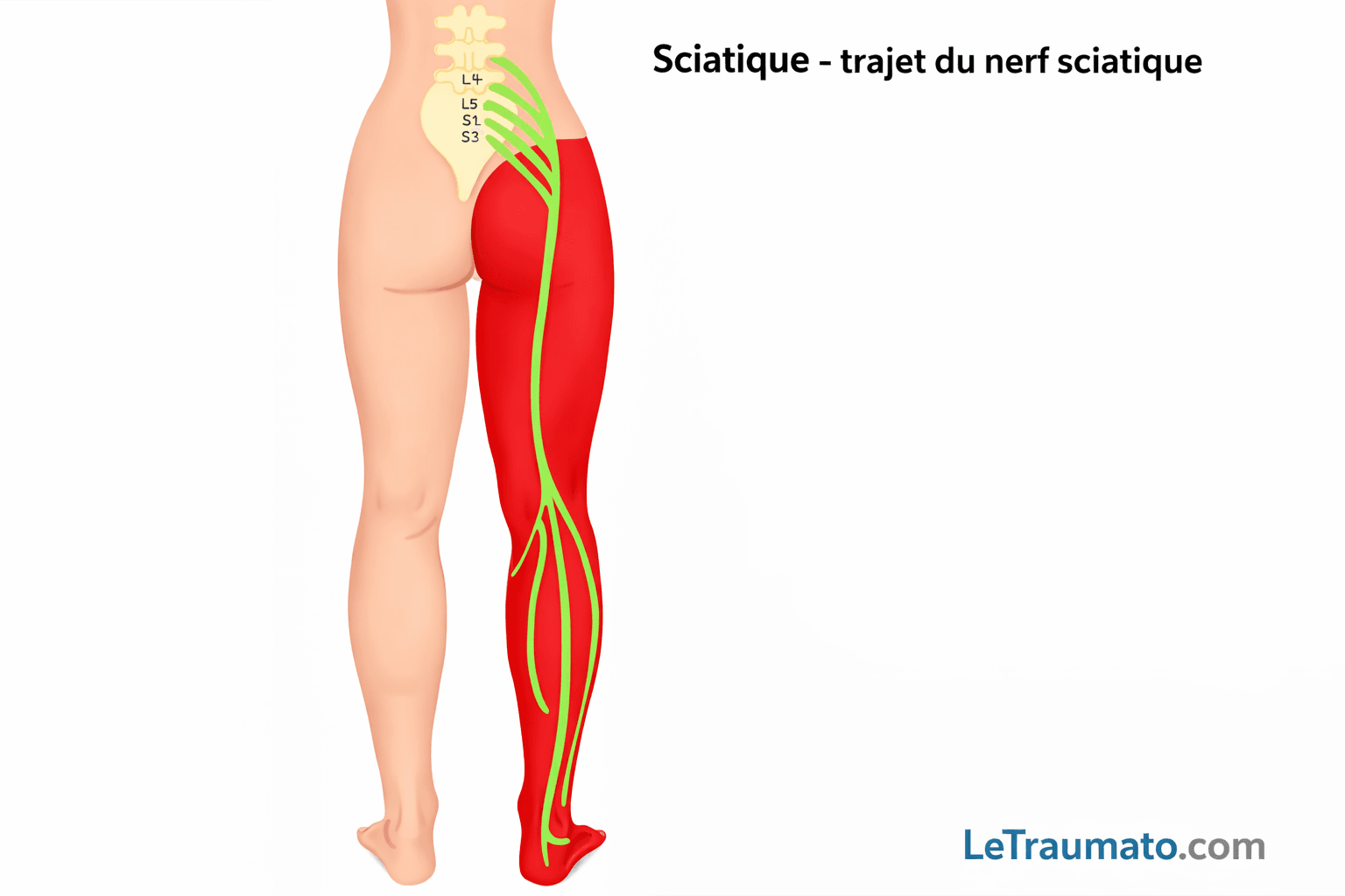 Illustration médicale montrant le trajet anatomique du nerf sciatique depuis la colonne lombaire L4 L5 S1 S2 S3 jusqu’à la jambe et au pied. Le nerf est représenté en vert et la zone douloureuse typique de la sciatique en rouge, au niveau de la fesse, de la cuisse, du mollet et du pied. Schéma pédagogique clair destiné à expliquer l’origine et la propagation des douleurs sciatiques.